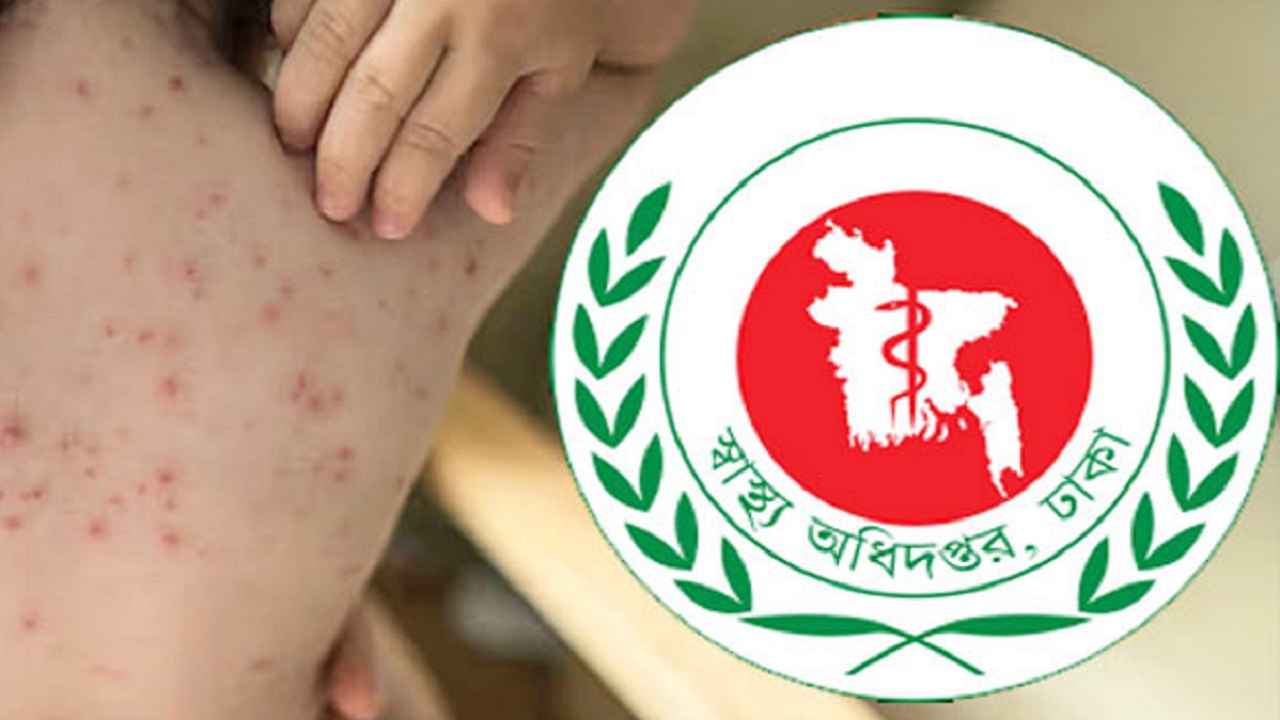 হাম ও উপসর্গে আরও ১০ শিশুর মৃত্যু